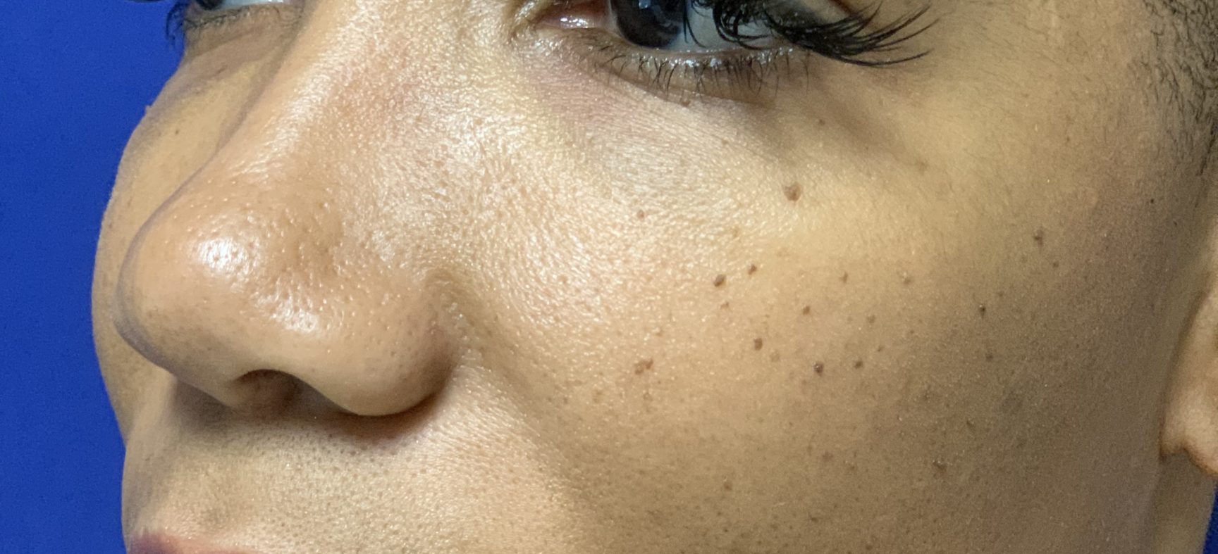 Rhinoplasty, ethnic nose surgery