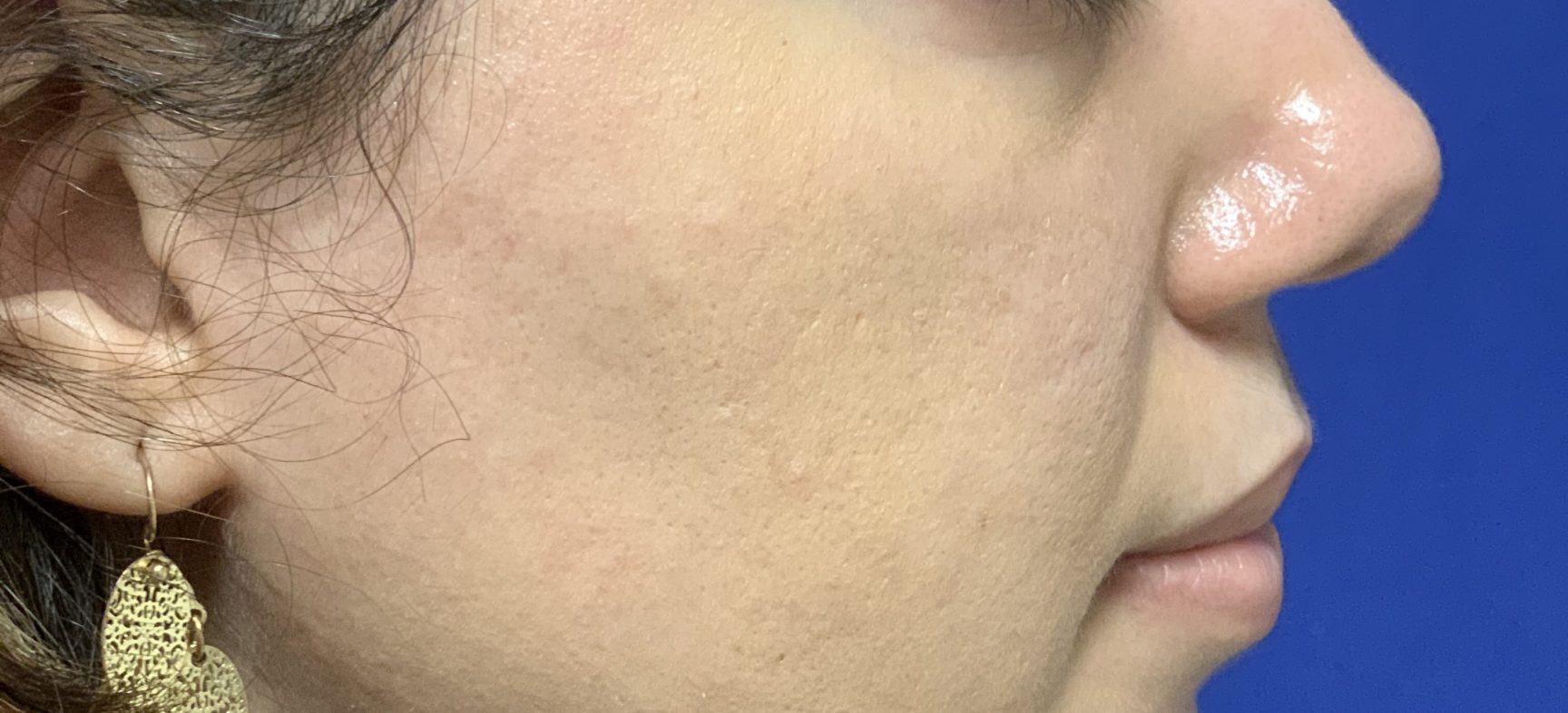 Neck liposuction and chin implant