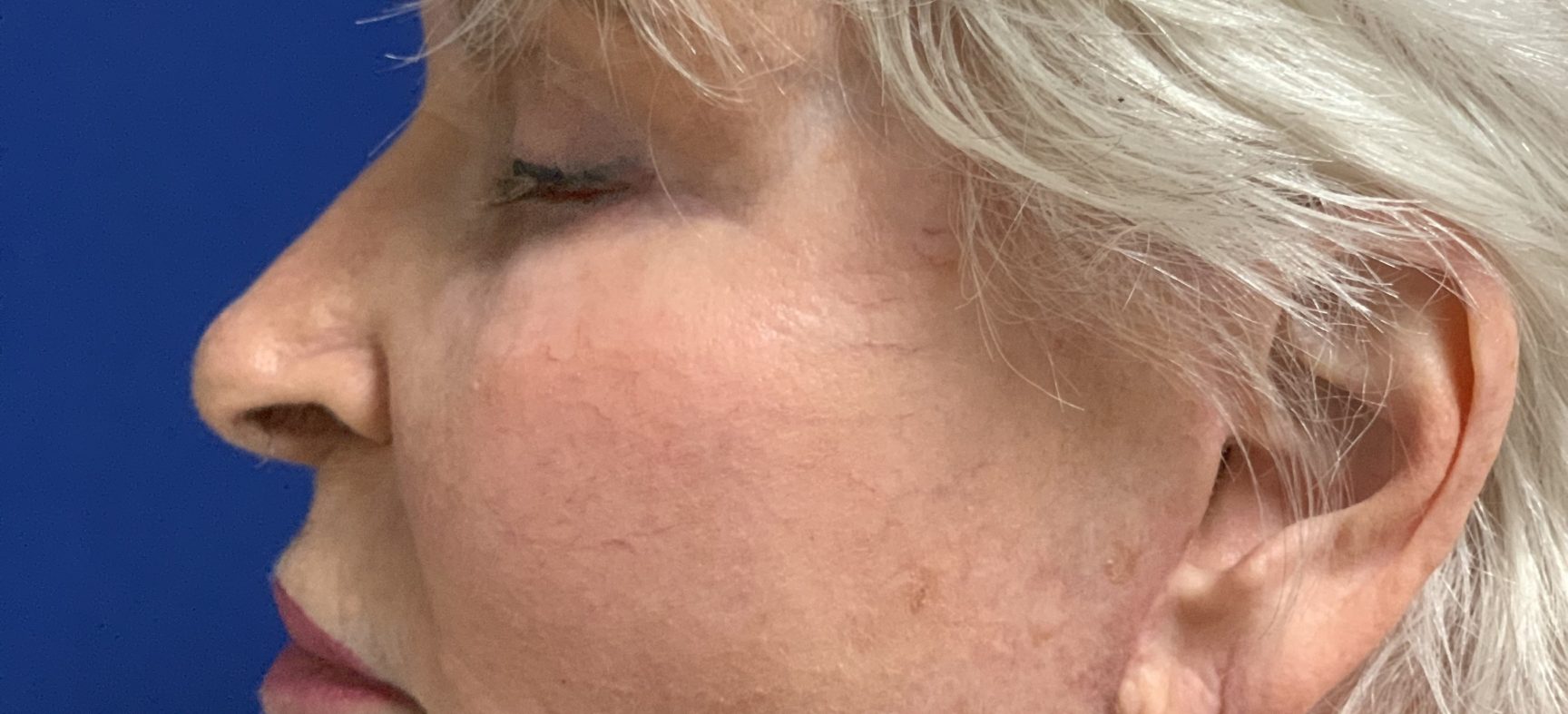 Secondary face lift