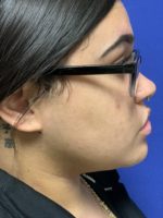 Neck Liposuction and Lipectomy - 14556