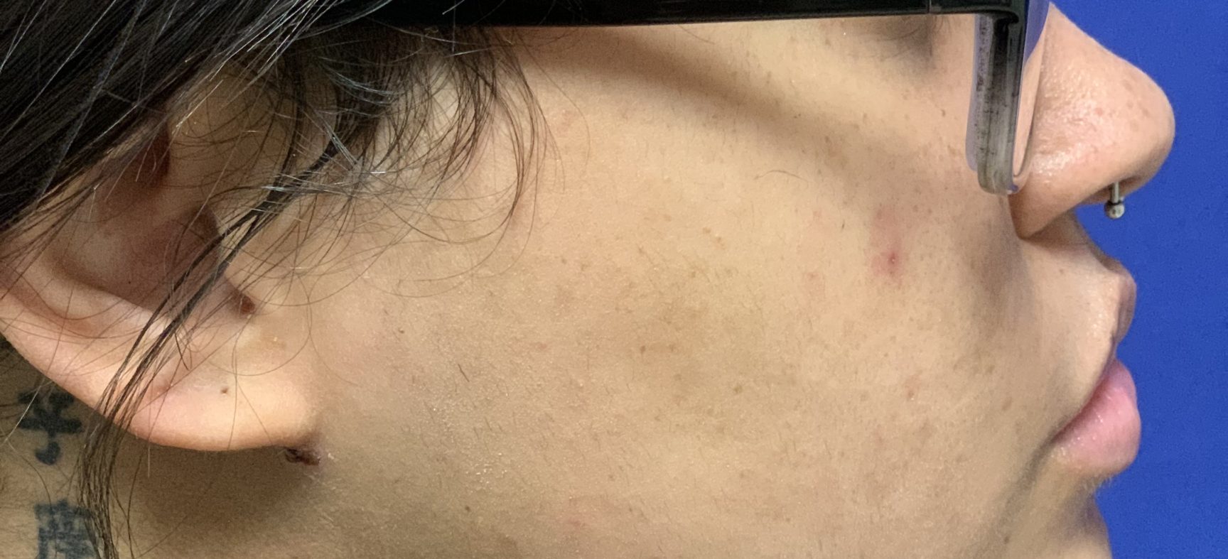 Neck Liposuction and Lipectomy - 14556