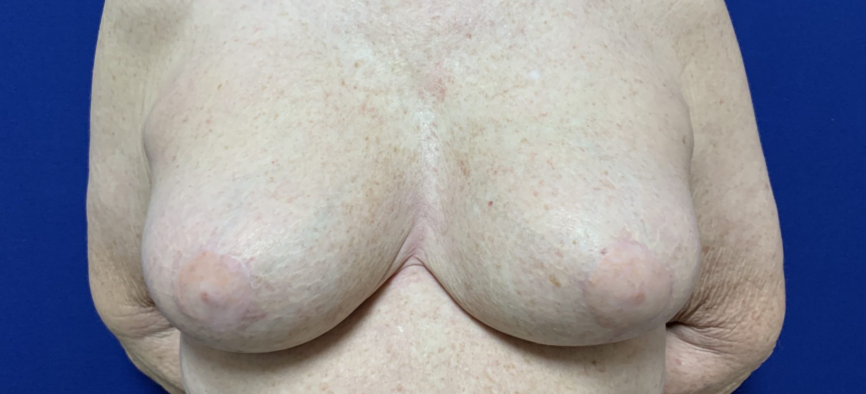Breast lift after implant removal