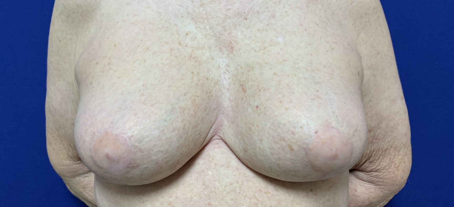 Breast lift after implant removal