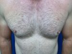 Male breast surgery- large nipples