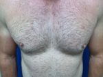Nipple reduction in male patient
