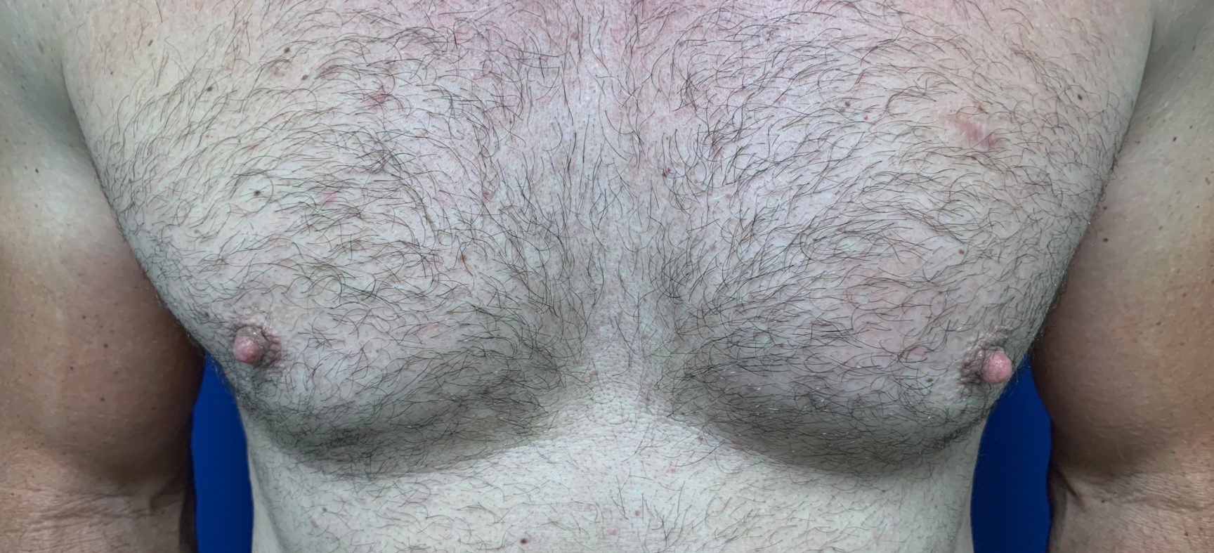 Male breast surgery- large nipples
