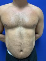 Liposuction of abdomen
