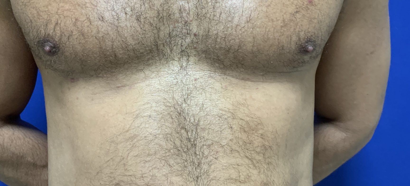 Liposuction of abdomen