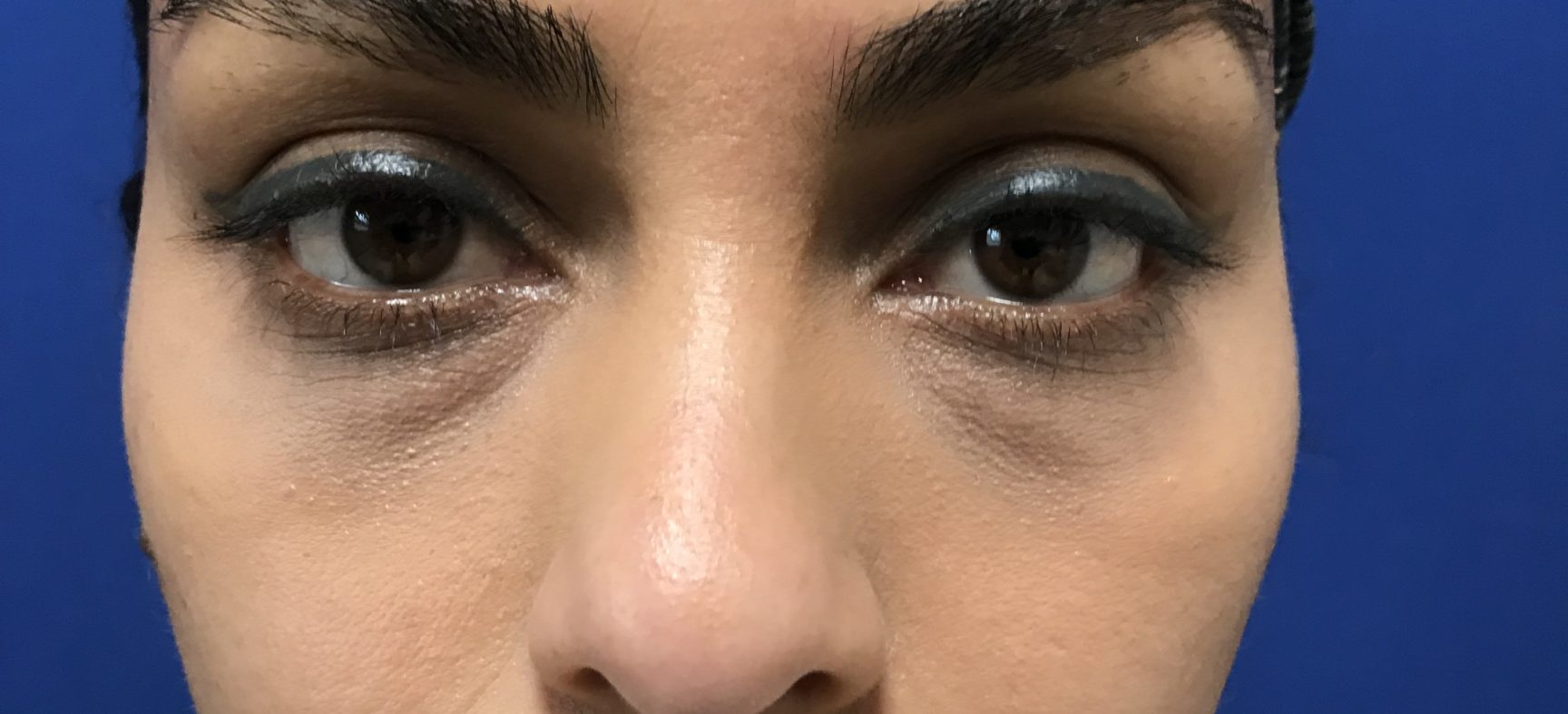 Lower Blepharoplasty, Transconjuctival