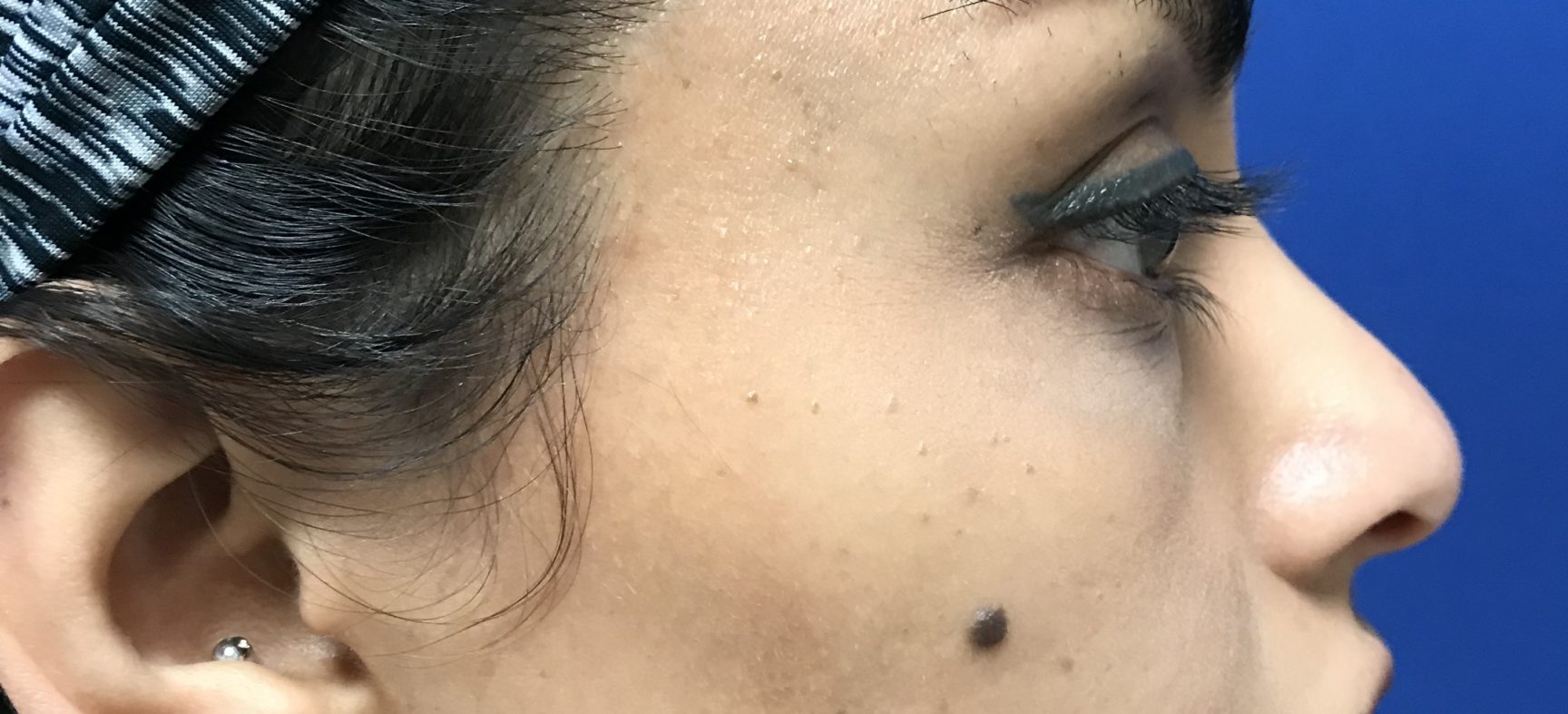 Rhinoplasty- nose surgery
