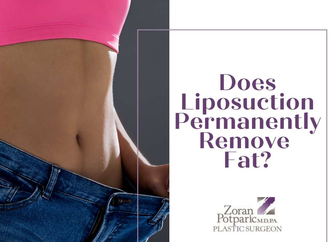 Does Liposuction Permanently Remove Fat?