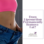 Does Liposuction Permanently Remove Fat?