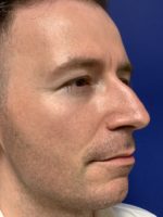Rhinoplasty, preservation rhinoplasty