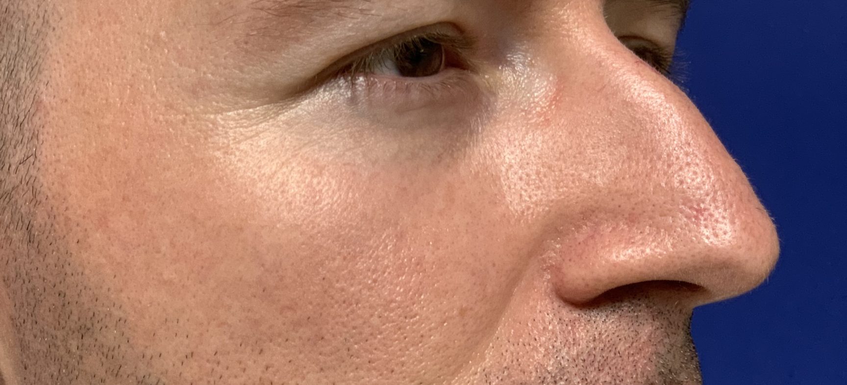 Rhinoplasty, preservation rhinoplasty