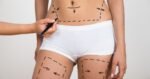 Should You Get Liposuction?