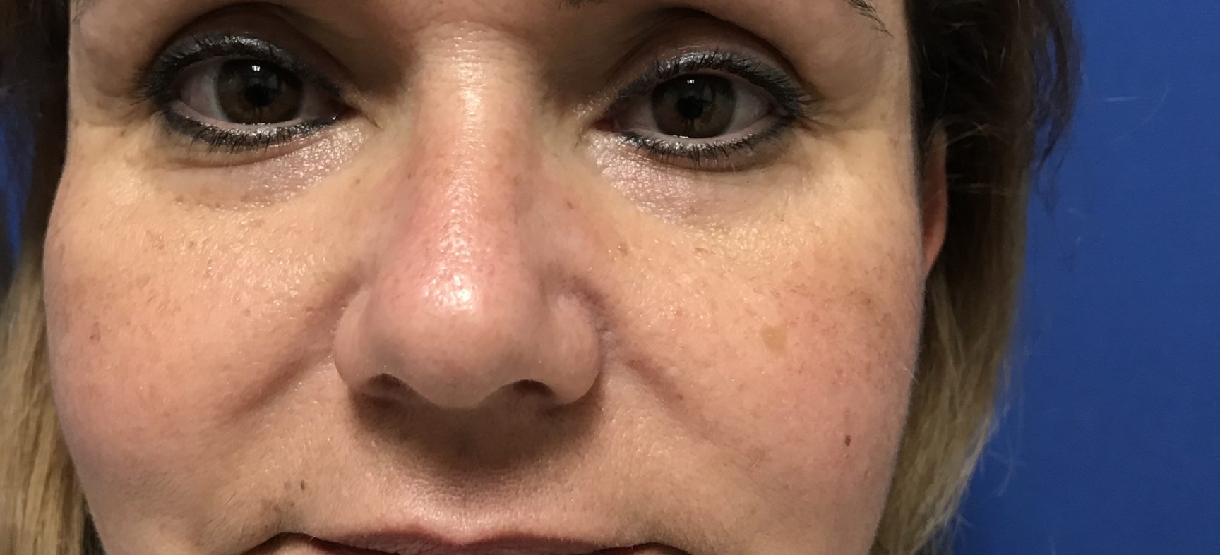 FACIAL FAT GRAFTS