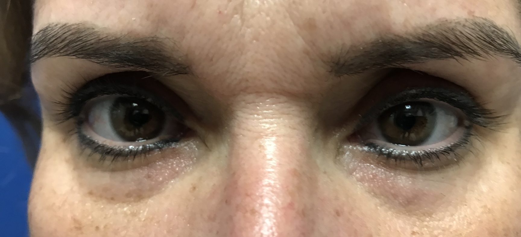 EYELID SURGERY-BLEPHAROPLASTY