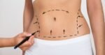 Mini Tummy Tuck Procedure