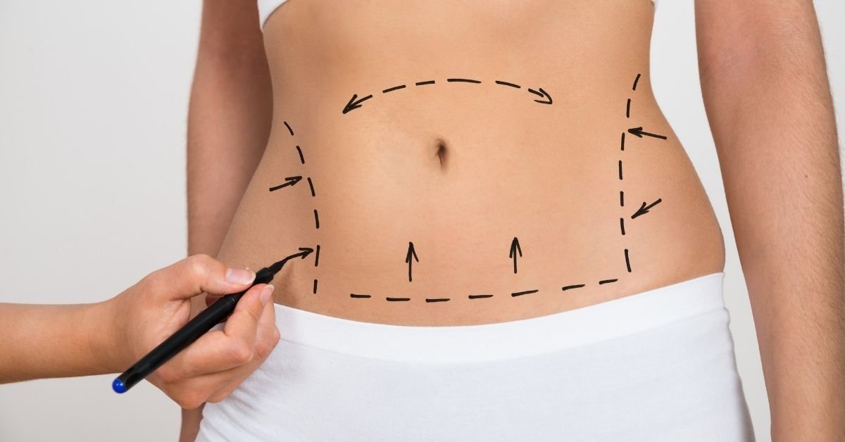 Mini Tummy Tuck Procedure