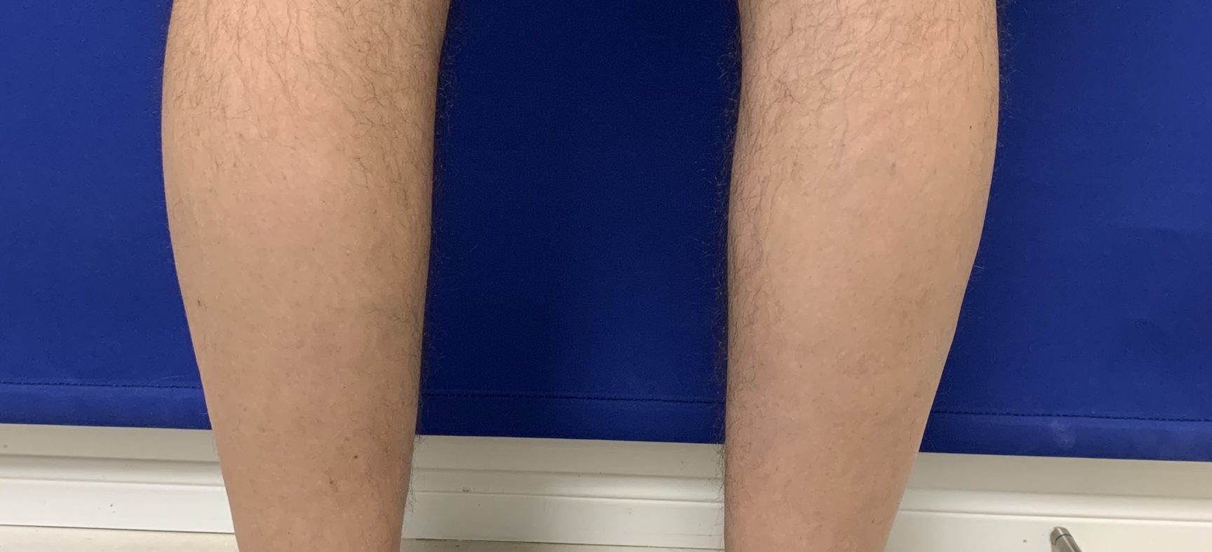 Calf Implants: Case 14271