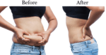 Does Fat Back After Liposuction?