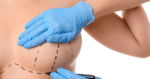 How to Decide on the Right Breast Augmentation Size?