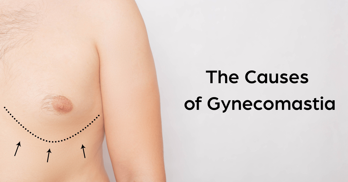 A photo of a man with gynecomastia. Arrows are drawn on him pointing towards the affected area. The text "the causes of gynecomastia" are present off to the right in black.