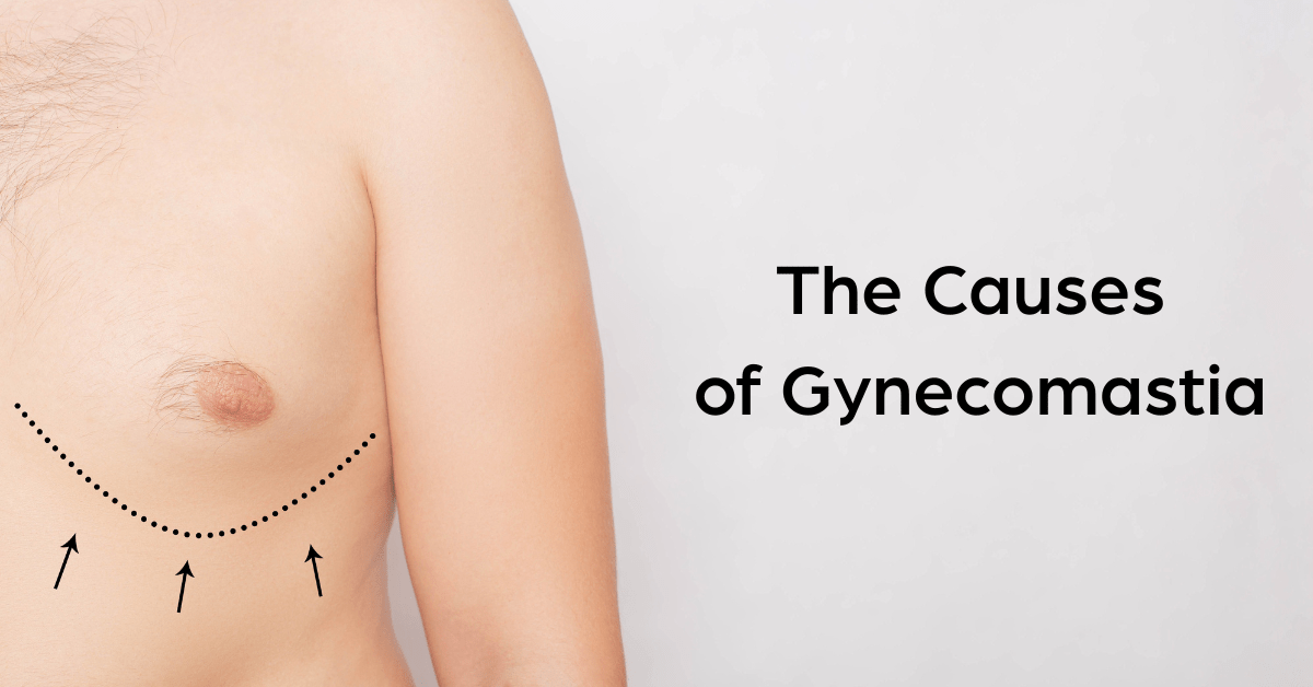Causes of Gynecomastia